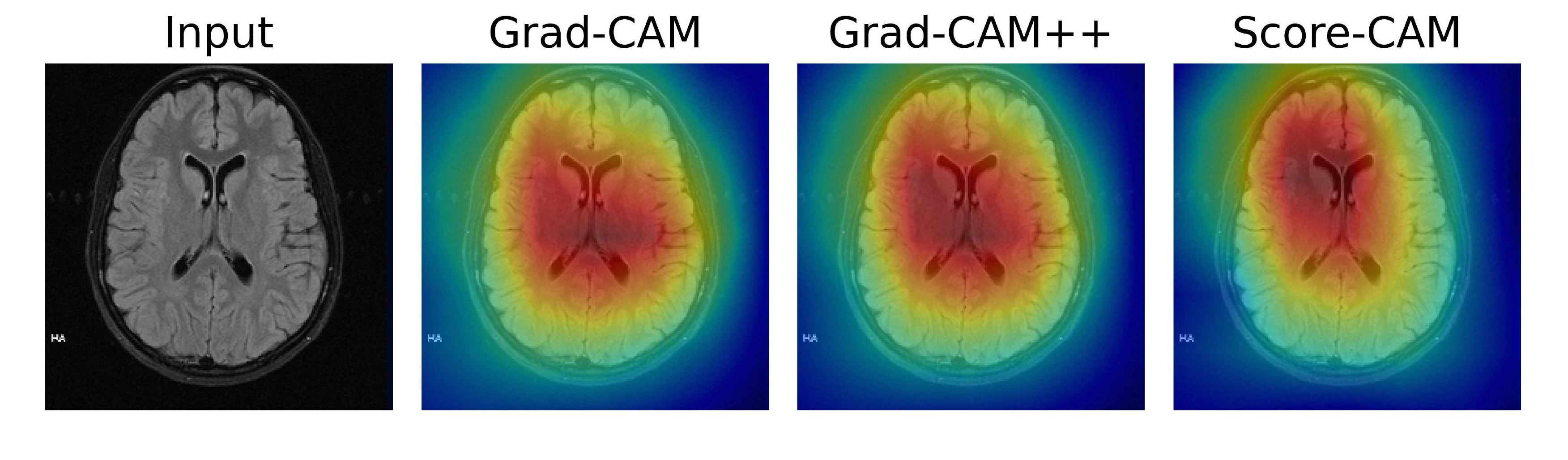 No Tumor